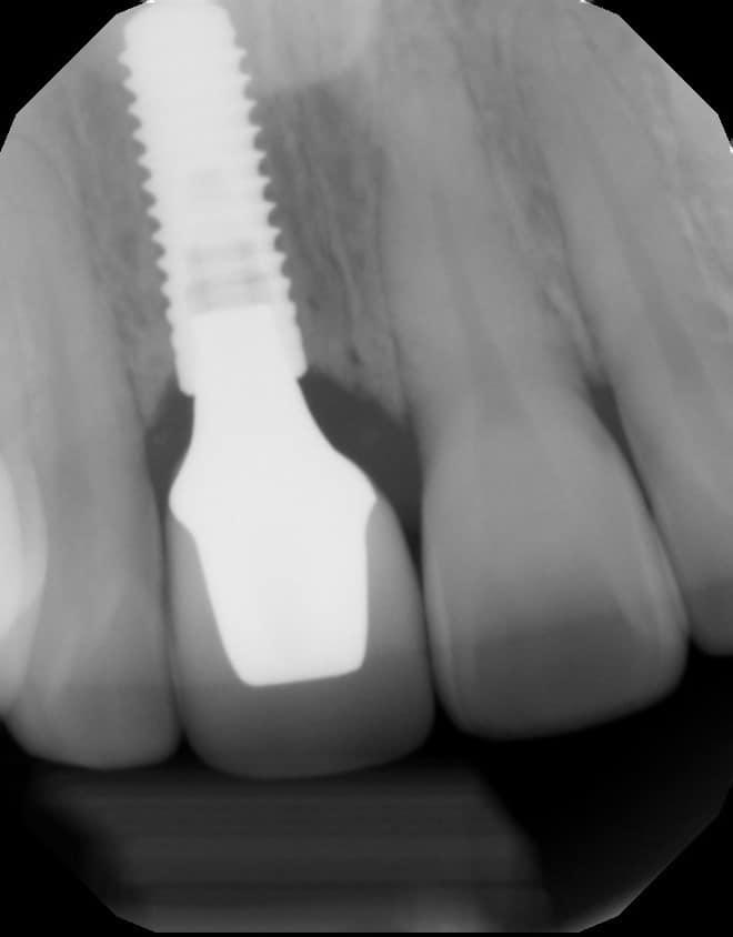 Dental implant X-ray